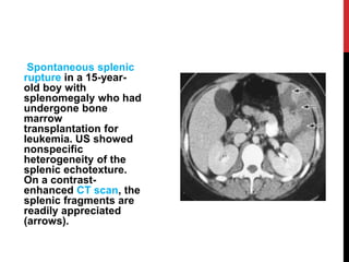Fresh Look at Diseases Of Spleen