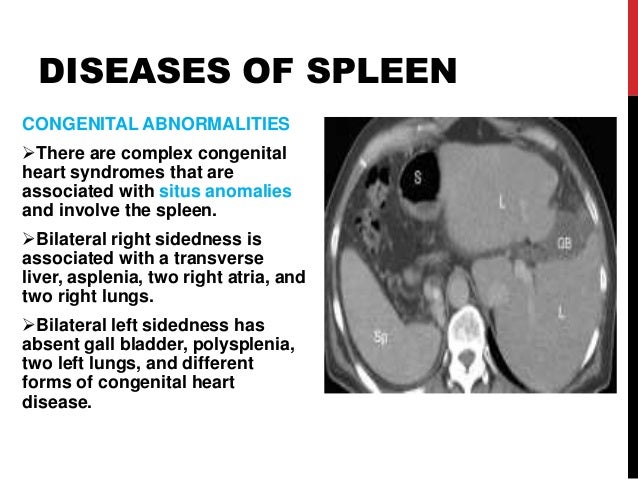 Diseases of spleen