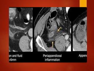 Comprehensive Overview of Acute Appendicitis and Appendix Neoplasms ...