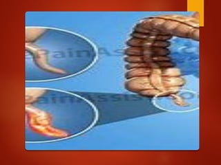 Comprehensive Overview of Acute Appendicitis and Appendix Neoplasms ...