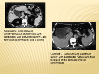 Diseases of the BILIARY SYSTEM 6th year..pptx