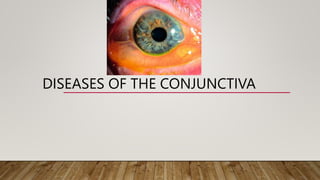 DISEASES OF THE CONJUNCTIVA
 