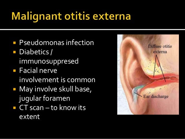What Is Cellulitis Of External Ear, Unspecified Ear? – UDNWIY