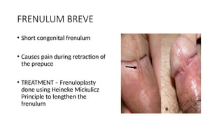 Frenulum Defect DISEASES OF THE FORESKIN and their management | PPTX