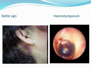 Diseases of the inner ear | PPTX