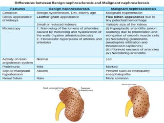 Diseases of the kidney | PPT