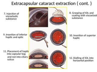 DISEASES OF THE LENS in preseptal and orbital cellulitis | PPTX