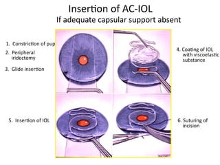 DISEASES OF THE LENS. ocular diseases one | PPTX