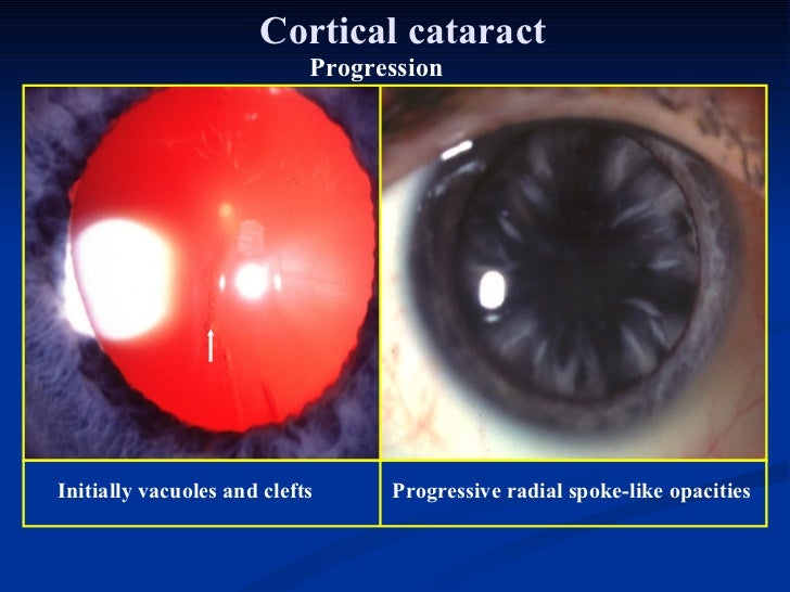 ophthalmology.Diseases of the lens.(dr.baxtyar)