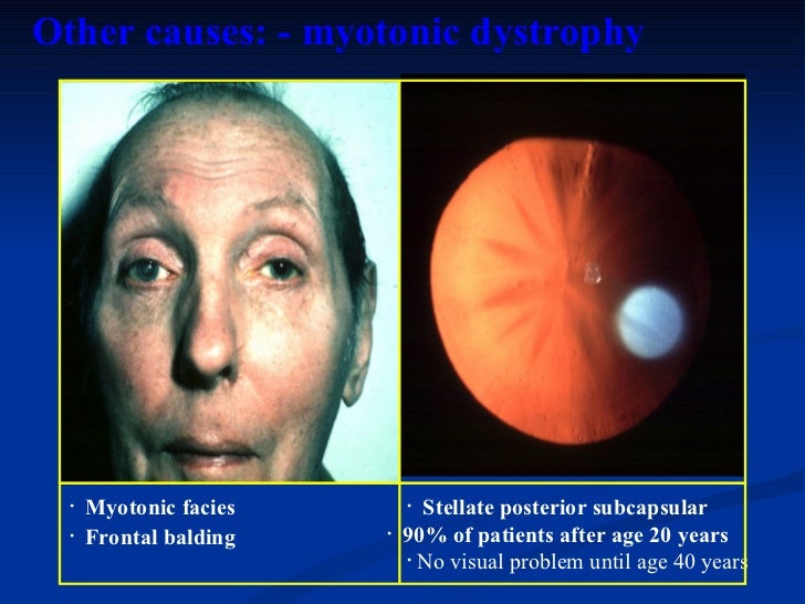 ophthalmology.Diseases of the lens.(dr.baxtyar)