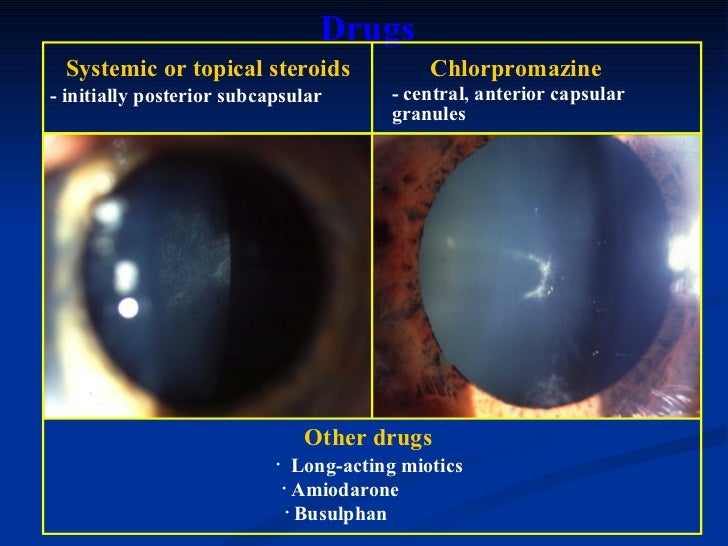 ophthalmology.Diseases of the lens.(dr.baxtyar)