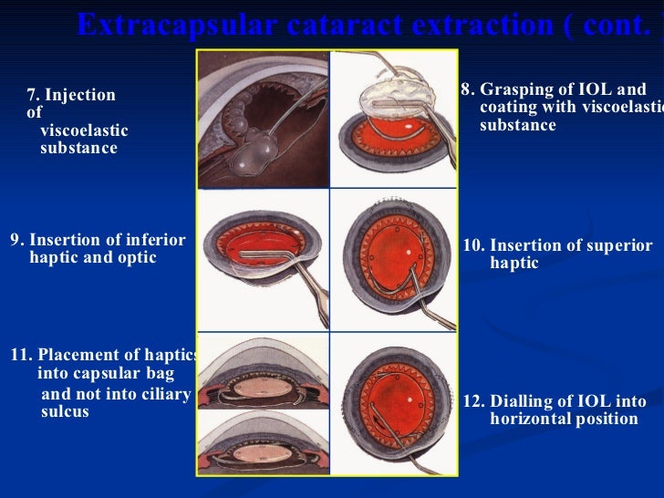 ophthalmology.Diseases of the lens.(dr.baxtyar)