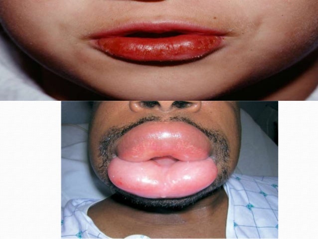 lip diseases