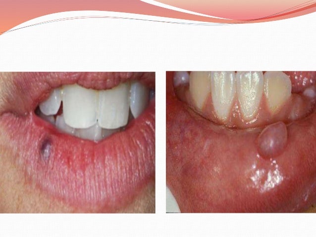 diseases of the lips and tongue lip diseases