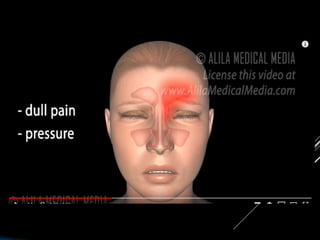 Nasal Septal Hematoma Wikipedia, 52% OFF