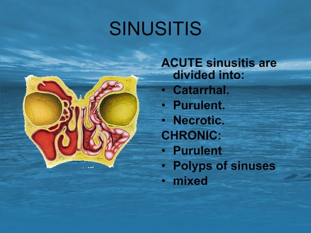 Diseases of the paranasal sinuses. | PPT