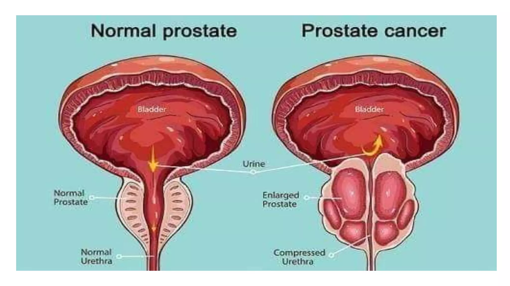 Diseases Of The Prostate