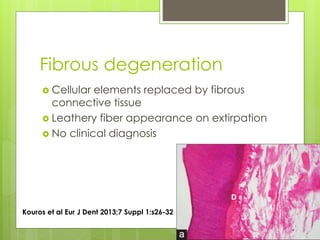 Fibrous degeneration
 Cellular elements replaced by fibrous
connective tissue
 Leathery fiber appearance on extirpation
 No clinical diagnosis
Kouros et al Eur J Dent 2013;7 Suppl 1:s26-32
 