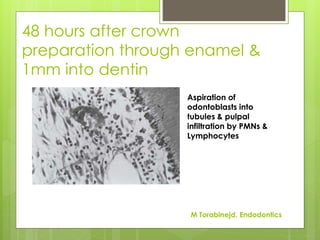 48 hours after crown
preparation through enamel &
1mm into dentin
Aspiration of
odontoblasts into
tubules & pulpal
infiltration by PMNs &
Lymphocytes
M Torabinejd. Endodontics
 