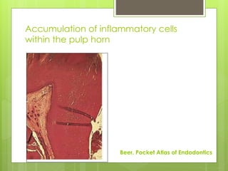 Accumulation of inflammatory cells
within the pulp horn
Beer. Pocket Atlas of Endodontics
 