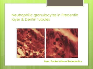 Neutrophilic granulocytes in Predentin
layer & Dentin tubules
Beer. Pocket Atlas of Endodontics
 