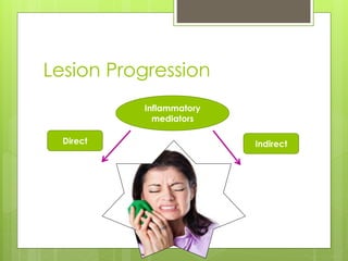 Lesion Progression
Inflammatory
mediators
IndirectDirect
 
