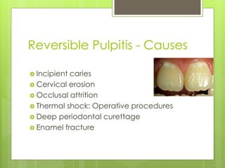 Reversible Pulpitis - Causes
 Incipient caries
 Cervical erosion
 Occlusal attrition
 Thermal shock: Operative procedures
 Deep periodontal curettage
 Enamel fracture
 