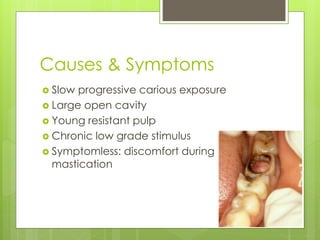 Causes & Symptoms
 Slow progressive carious exposure
 Large open cavity
 Young resistant pulp
 Chronic low grade stimulus
 Symptomless: discomfort during
mastication
 