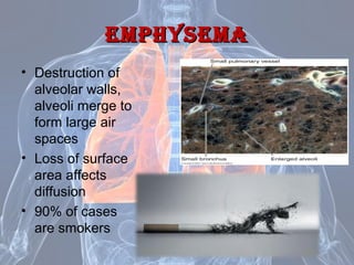 Emphy Diseases of the respiratory system | PPT