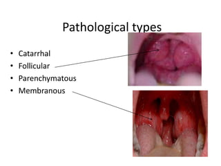 Diseases of the throat by Dr. Kavitha Ashok Kumar MSU Malaysia | PDF