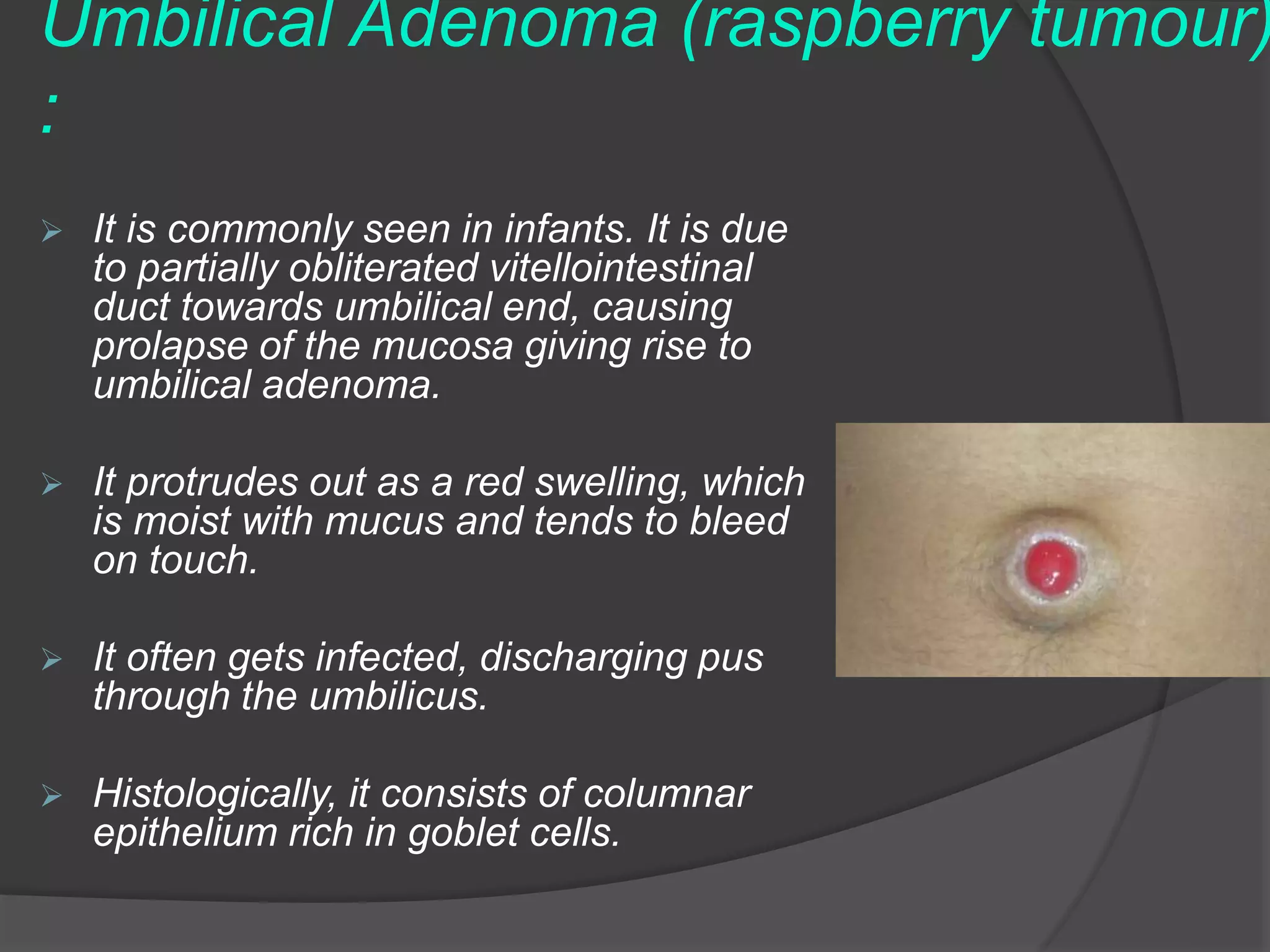DISEASES OF THE UMBILICUS pptx