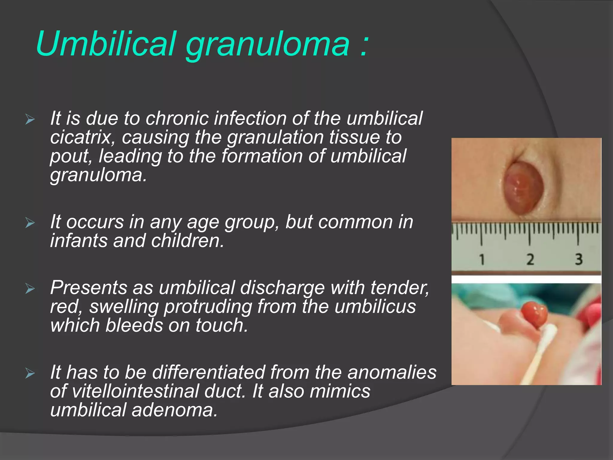 DISEASES OF THE UMBILICUS pptx