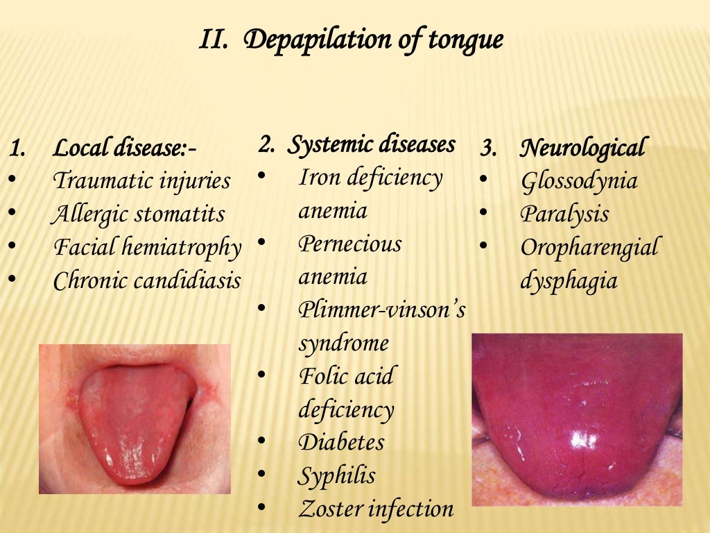 Diseases of tongue