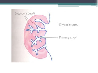 Diseases of tonsils and adenoids | PPTX