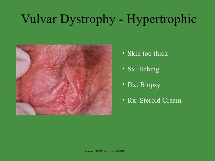 Vulvar ulcers: a differential diagnosis between Behçet’s ...