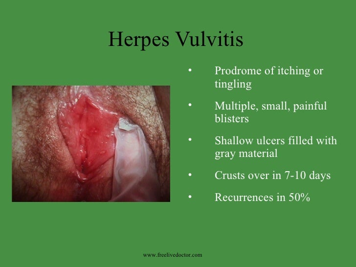 Sores, Blister on Vagina: Causes, Treatment for Vaginal ...