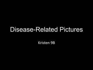 Disease-Related Pictures
         Kristen 9B
 