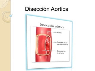 Disección Aortica
 