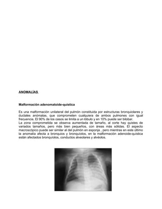 ANOMALÍAS


Malformación adenomatoide-quística

Es una malformación unilateral del pulmón constituida por estructuras bron...