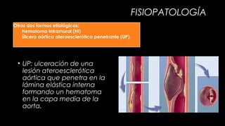 FISIOPATOLOGÍA
Otras dos formas etiológicas:
Hematoma intramural (HI)
Úlcera aórtica ateroesclerótica penetrante (UP).

• UP: ulceración de una
lesión ateroesclerótica
aórtica que penetra en la
lámina elástica interna
formando un hematoma
en la capa media de la
aorta.

 