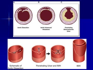 Aortic dissection GP | PPT