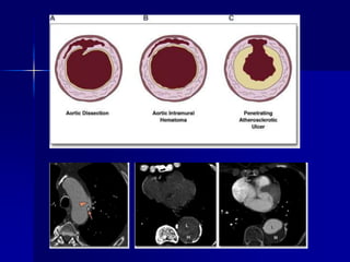 Aortic dissection GP | PPT