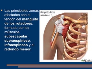 Las principales zonas 
afectadas son el 
tendón del manguito 
de los rotadores, 
formado por los 
músculos 
subescapular, 
supraespinoso, 
infraespinoso y el 
redondo menor, 
 