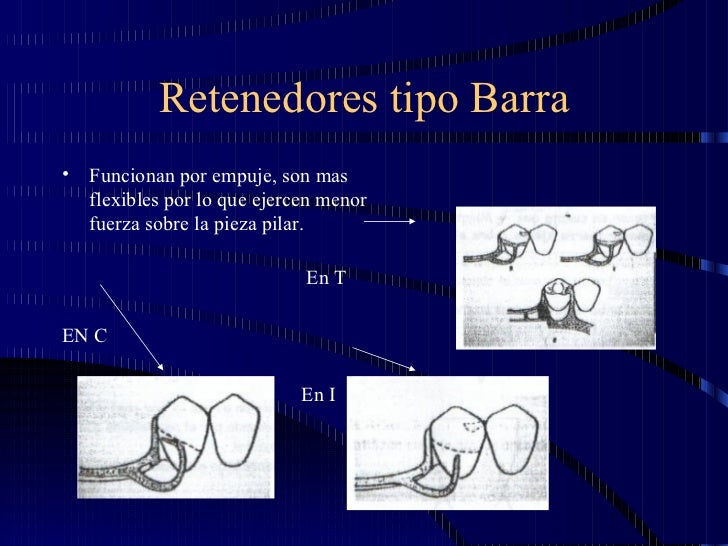 diseño protesis parcial removible