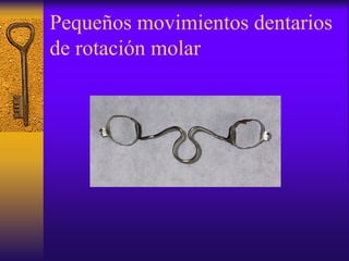 Pequeños movimientos dentarios
de rotación molar

 