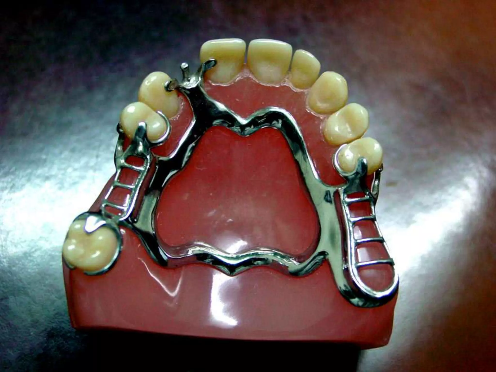 Diseño de protesis parcial removible