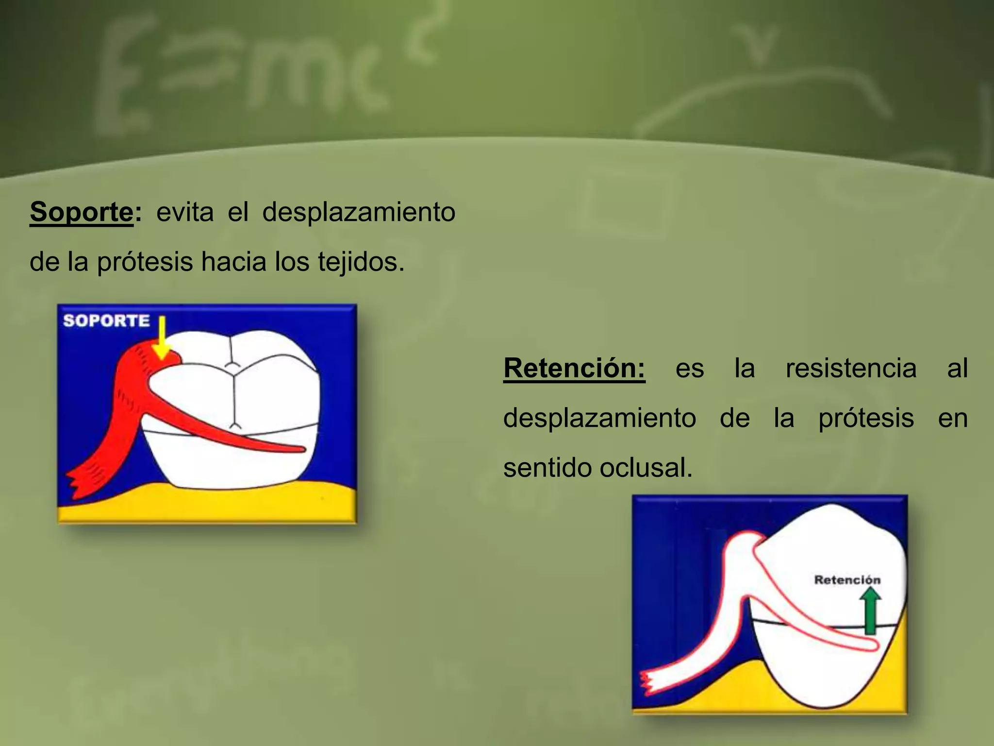 Diseño de protesis parcial removible