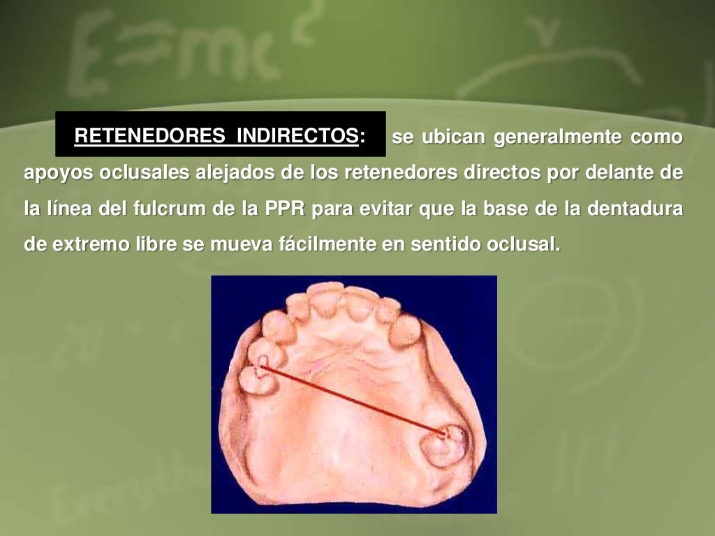 Diseño de protesis parcial removible