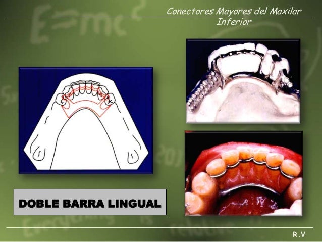 barra lingual superior dise 241 o de protesis parcial removible barra lingual superior dise 241 o de protesis parcial removible
