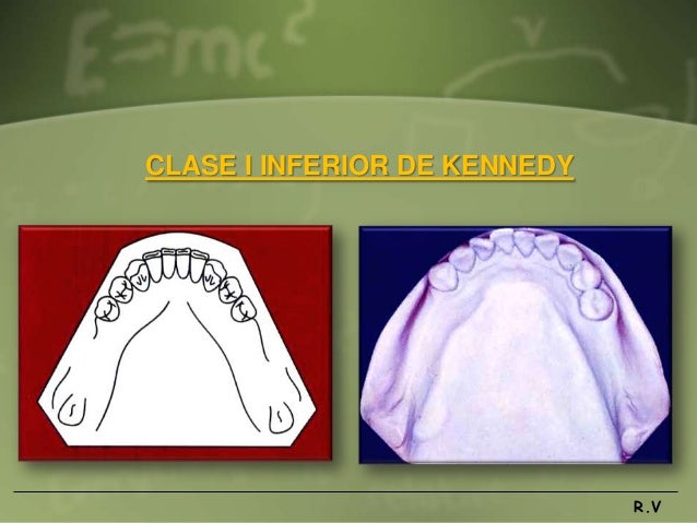 Diseño de protesis parcial removible